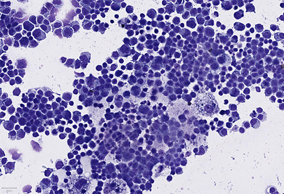 May Grunewald Giemsa (MGG) stain of a cytospin.jpg