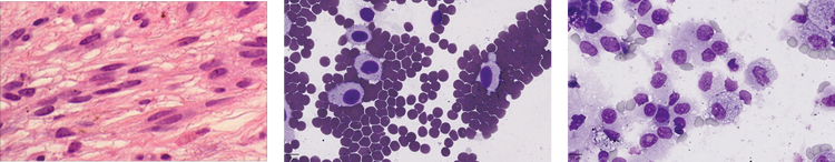 April 26 Bulletin_Occular cancer_Figure 1 d-f.png