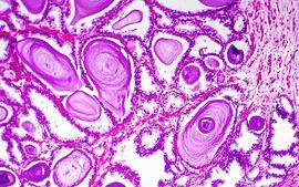 Histopathology of prostate gland hyperplasia_sm.jpg