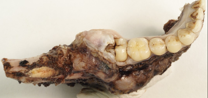 Macroscopic photograph of mandibulectomy specimen for excision of an ameloblastoma at the posterior aspect of the mandible.