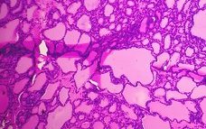 sarcoma histology