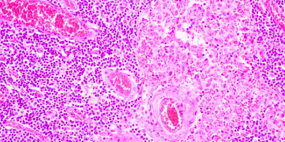 Image from section tissue of breast cancer view in microscopy_lower res for web.jpg