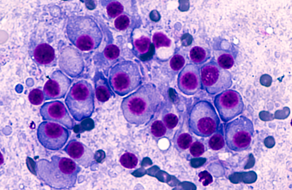 Multiple myeloma cell slide.