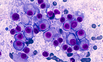 Multiple myeloma cell image_resize.png