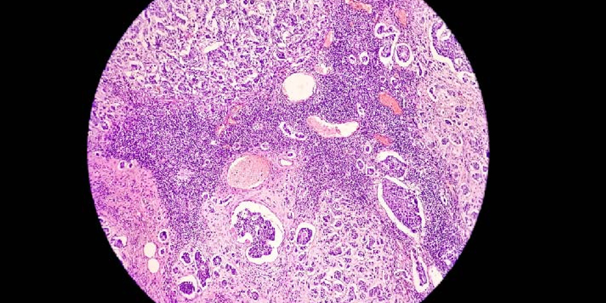 Breast cancer awareness Microscopic image (photomicrograph) of core biopsy for infiltrating (invasive) ductal carcinoma_lower res for web.jpg