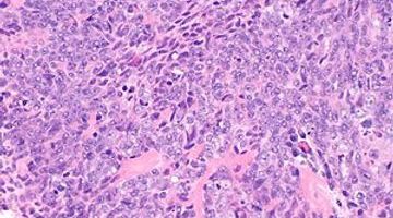 300px-Nasopharyngeal_carcinoma_-_alt_--_high_mag.jpg