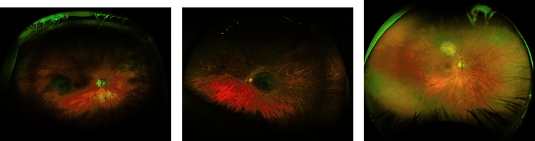 April 26 Bulletin_Occular cancer Figure 1a-c.png