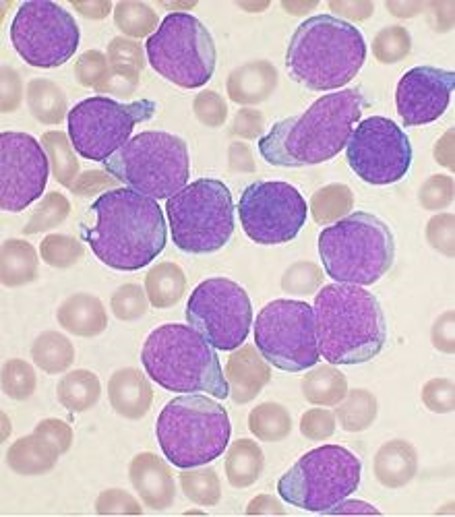 Acute leukaemia cells under the microscope.jpg
