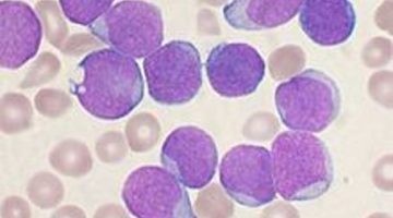 Acute leukaemia cells under the microscope.jpg