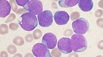 Acute leukaemia cells under the microscope.jpg