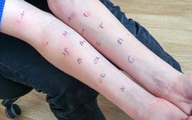 allergy_skin_test_dermatopathology_immunology_38222193_785x400px.jpg